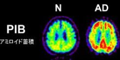 血液検査でアルツハイマー病の早期予測　東大など