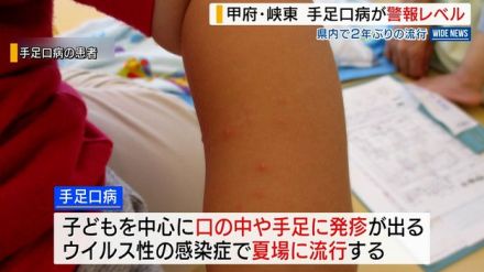 「手足口病」警報レベルに 甲府と峡東 県内では2年ぶり 手洗いなど呼びかけ 山梨県