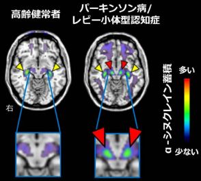 パーキンソン病の原因物質、脳内の可視化に成功　治療法開発に期待