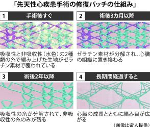 血管修復パッチで「心臓病の子供救う」産学の垣根越えて　困難極めた１０年超、執念の実用化