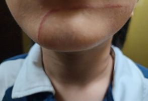 韓国・小1の担任「息子さん、ちょっと引っかかれた程度の傷」…実は絆創膏の下に「衝撃の傷口」