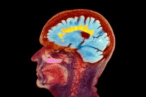 多発性硬化症とは、中枢神経系の難病について今知っておきたいこと、早期発見が重要
