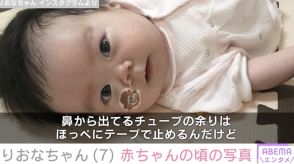 先天性疾患による低身長・りおなちゃん（7）「鼻から胃に通したチューブで栄養をとっていました」生後間もない写真を公開