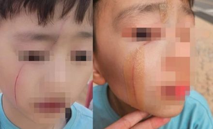 “凶器”は鉛筆、上級生に顔を引っ掻かれた「痛々しい」児童の顔…韓国・保護者「校内暴力だ」