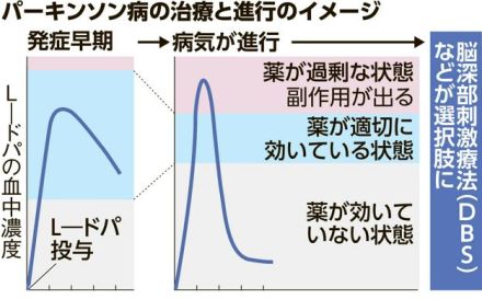 高齢化、増えるパーキンソン病　症状抑制より長く　原因除く研究も