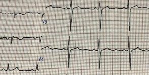 健康診断で心電図異常、軽度でも心不全のリスクに　370万人を分析