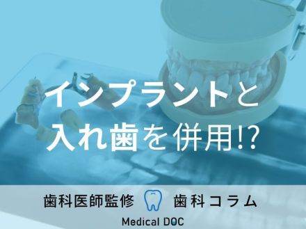 インプラントと入れ歯の“併用”で噛み心地を改善できる!? メリット・デメリットを歯科医が解説!