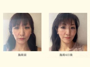 エステ施術でたるみ改善！50代美容賢者のビフォー・アフター