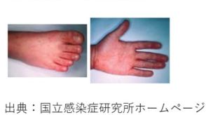 手足口病患者が増えているとして岡山県が注意喚起　手洗いの徹底　タオル共用を避ける　集団生活でのトイレやおむつ交換などに注意を