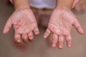 「手足口病」が流行中、各地で警報が！「突然の熱から手と足、おしりにブツブツが・・・」子どもから親にうつることも。予防策は？【小児科医】