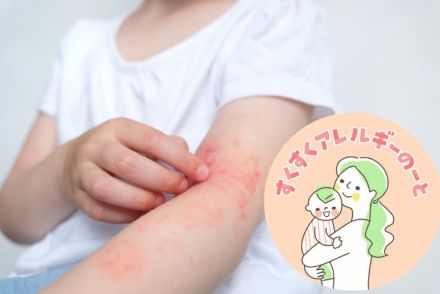 子どもが「食物アレルギー」になった時、知っておくべき5カ条とは？