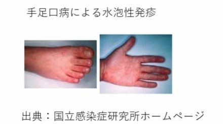 幼稚園で「手足口病」による学級閉鎖「手足口病が増えている」県が注意を呼びかけ【岡山・倉敷市】