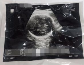 「お腹が燃えて裂かれるような気分」…妊娠９カ月堕胎Ｖｌｏｇが炎上＝韓国