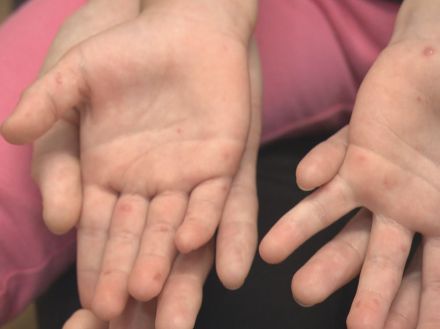 医師「状態次第では髄膜炎にも」5歳以下の子供が感染する“手足口病”が流行中 熱中症との合併等に注意