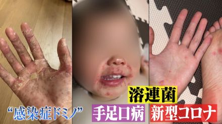 手足口病に溶連菌、新型コロナ…猛暑を襲う”警報級”感染症　家族が次々罹患する“感染症ドミノ”も発生　対策は?