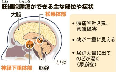 若い世代に多い脳腫瘍「胚細胞腫瘍」　意識障害、視力低下も