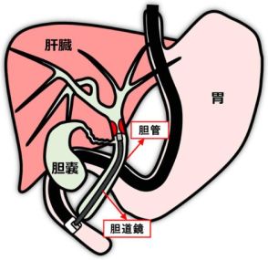 岡山大学病院と両備システムズ、 胆道がんの診断をAIで支援するシステムを開発