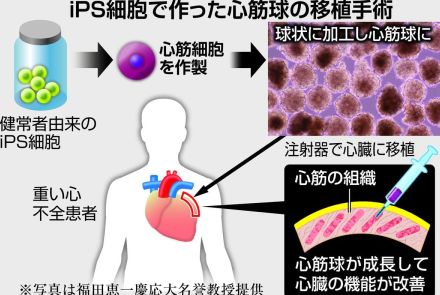 ＜独自＞ｉＰＳ心筋球移植、治験で細胞量３倍に　安全委承認、心機能の改善効果増強