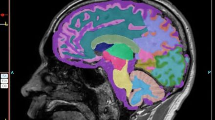 帯状疱疹ワクチンで認知症リスク低下の可能性　米研究