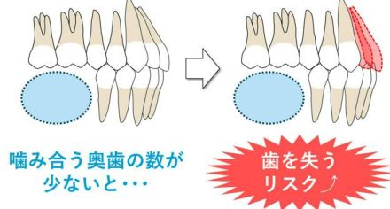 奥歯のかみ合わせの悪化、歯を失うリスクが最大6倍に　10万人調査