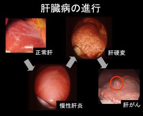 飲酒や肥満、糖尿病がリスクに ～自覚症状時には手遅れのケースも―肝がん～