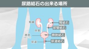 バットで殴られたような痛みが何度も　暑い夏は痛みの王様「尿路結石」のハイシーズン　自分で出来る予防法