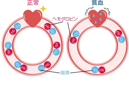 更年期に多い動悸は、貧血や心臓病も疑って！【更年期症状と間違えやすい病気に要注意！ ⑤】