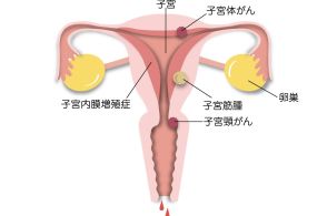 閉経前の月経不順と、子宮がんの不正出血を間違えないで！【更年期症状と間違えやすい病気に要注意！ ⑥】