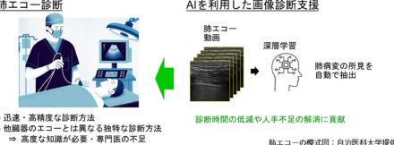 肺病変の所見を高精度・高速に自動検出するAI　産総研が開発、ディープラーニングを応用