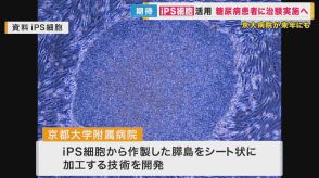 1型糖尿病の治療に期待　iPS細胞から膵島細胞をシート状に加工　京大病院が治験へ　2030年以降に実用化目指す