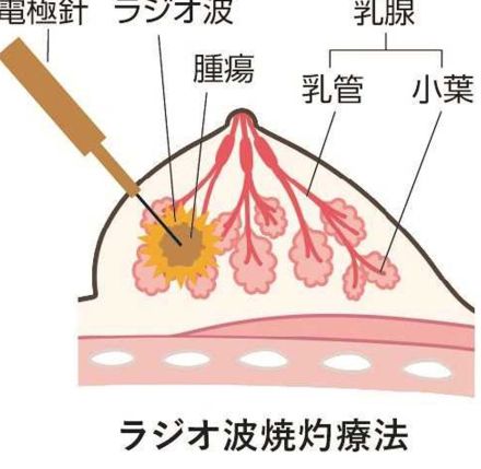 乳がん切除せず治療「ＲＦＡ」実施、岐阜県内２施設目　中部国際医療センター