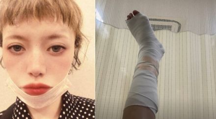 広田レオナさん　「足首骨折してるみたい」　痛々しい足の写真をアップ　アスファルトが崩れて「転んでしまった」