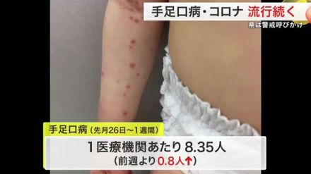 手足口病 宮城県内で微増…新型コロナとともに流行続く 「お盆明けは警戒を」県が対策呼びかけ