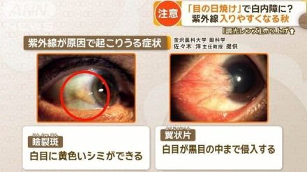 「目の日焼け」白内障や老眼に？　紫外線入りやすくなる秋　熱中症で白内障リスク4倍