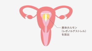 「ミレーナ」は避妊具なのに、生理も楽になるって本当？