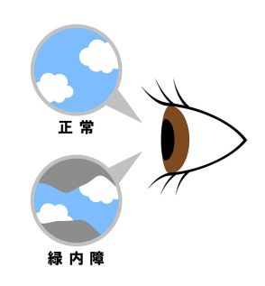 ひっそりと忍び寄る緑内障―減った神経は元に戻らない～睡眠時無呼吸症候群との関連も～