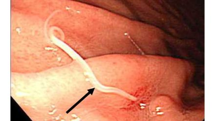 粘膜にもぐり込み穴が空くことも!?胃や腸に激痛が走るアニサキス症…疑いがあったらどうすればいいのか聞いた